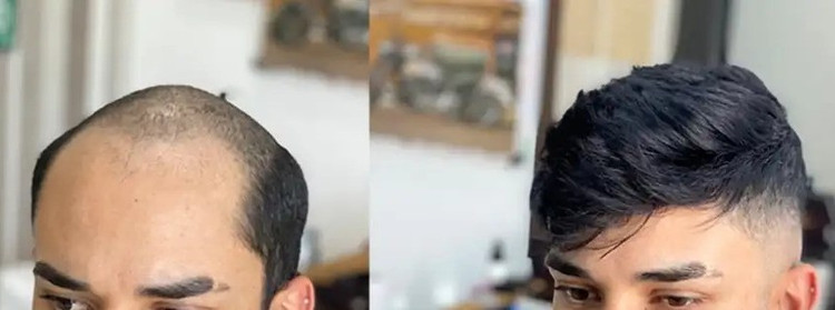 پروتز کف سر مردانه