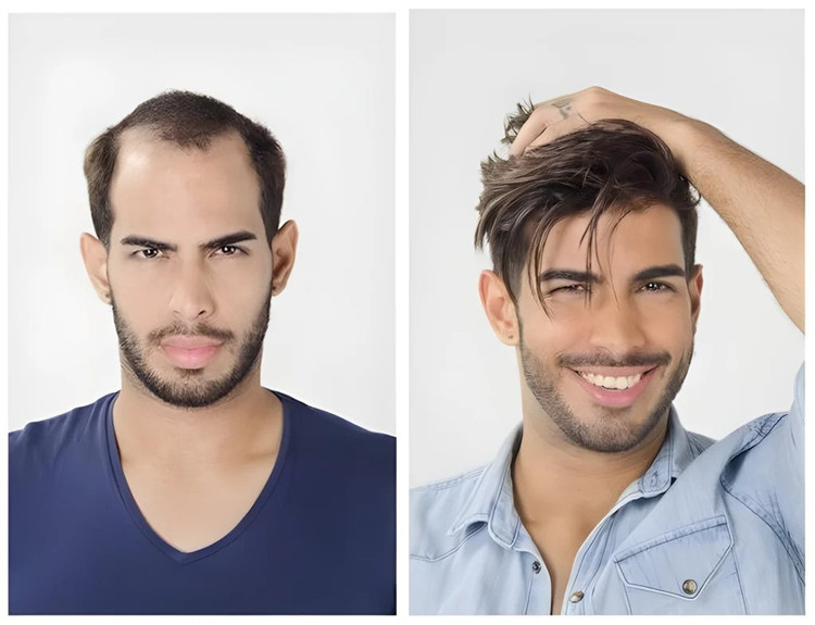 پروتز بالا سر مردانه